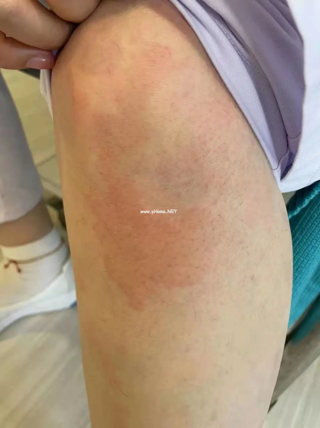 当心！这个春季常见病专挑孩子下手，一定要尽早预防！（不是手足口）