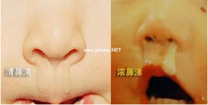 以为是鼻涕，结果是脑脊液，孩子的“鼻涕”没那么简单