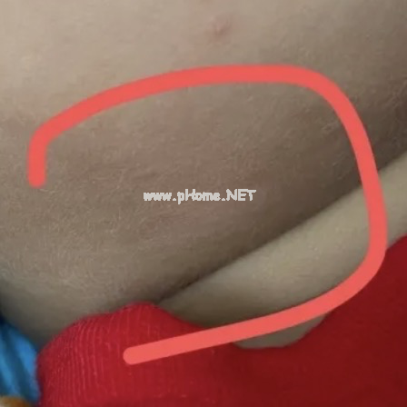 孩子皮肤白了一块？多半是这4种皮肤病