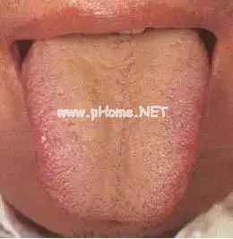 【收藏】61张高清舌诊图谱，图文对照