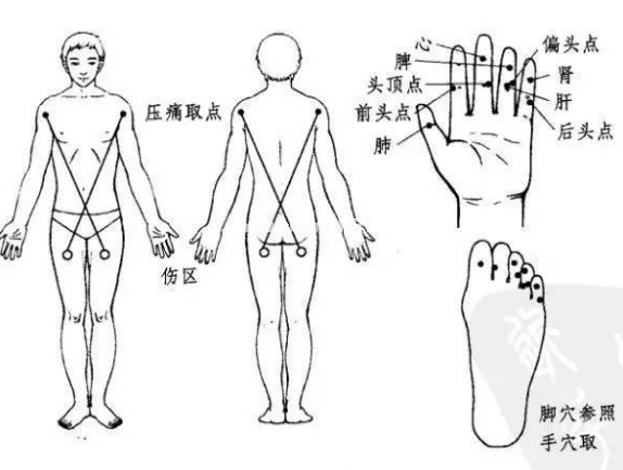 中风偏瘫，“治瘫点”是最方便的疗法