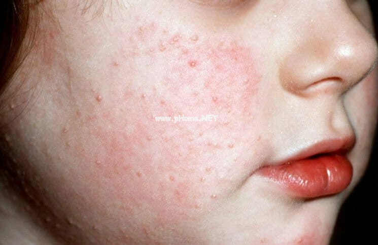 以面部丘疹为例，讨论小儿丘疹性疾病的鉴别