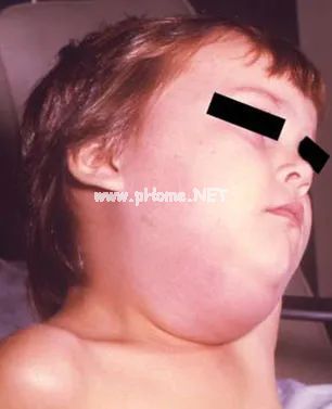看一眼就传染！这病专挑孩子下手，搞不好还影响生育（不是新冠！）