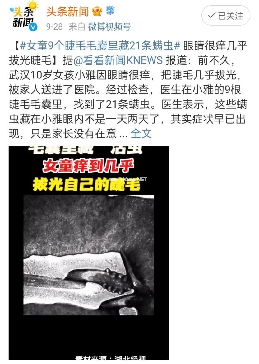 ​痒痒痒，女童睫毛里竟藏21条螨虫