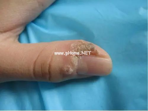 孩子身上长瘊子，竟是感染了HPV？