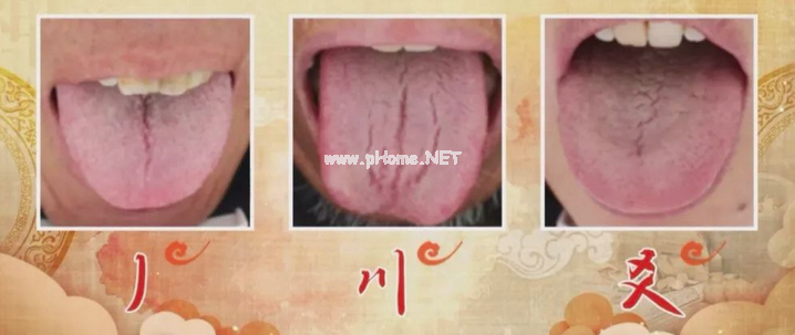 两种舌象：可能是癌症高危人群？