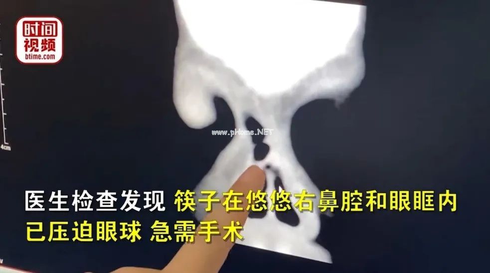 2岁儿童摔倒，筷子直接从鼻腔插入眼眶……