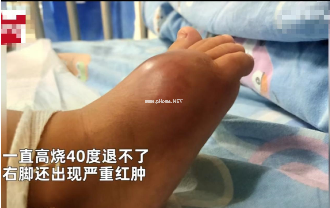 8月宝宝因败血症送进ICU,只因家长这个简单动作...... 8月宝宝因败血症送进ICU,只因家长这个简单动作......