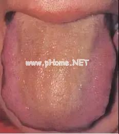 【收藏】61张高清舌诊图谱，图文对照