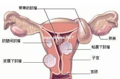 子宫肌瘤三大起因：一是炎，二是寒，三是...?