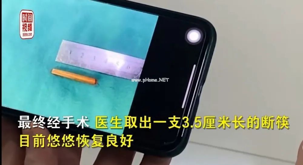 2岁儿童摔倒，筷子直接从鼻腔插入眼眶……