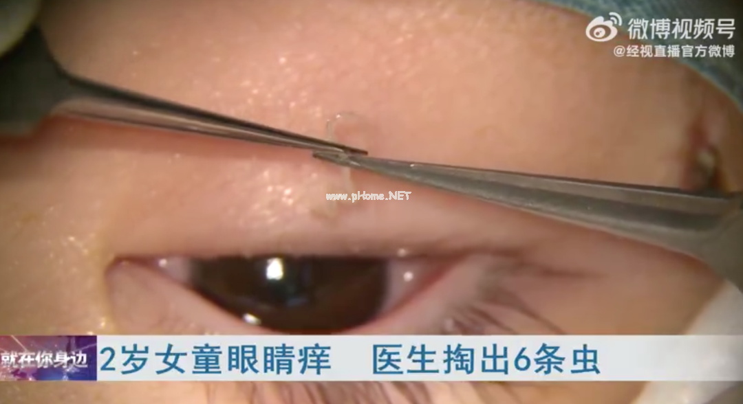 又一例！2岁女童眼里取出6条活虫！身边有这个，千万要注意！