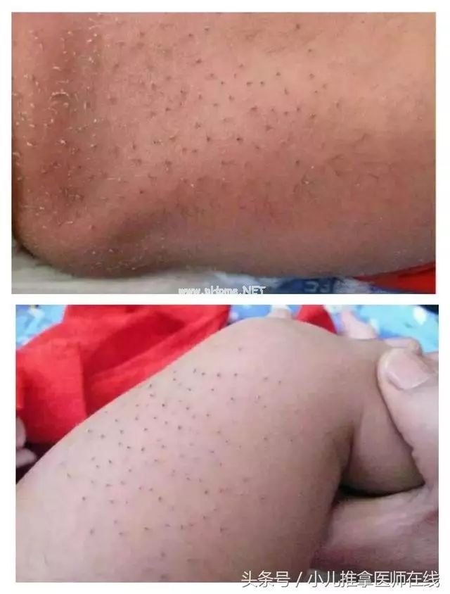 如何科学看待猪毛风，程老师详细介绍“小儿猪毛风”的前世今生