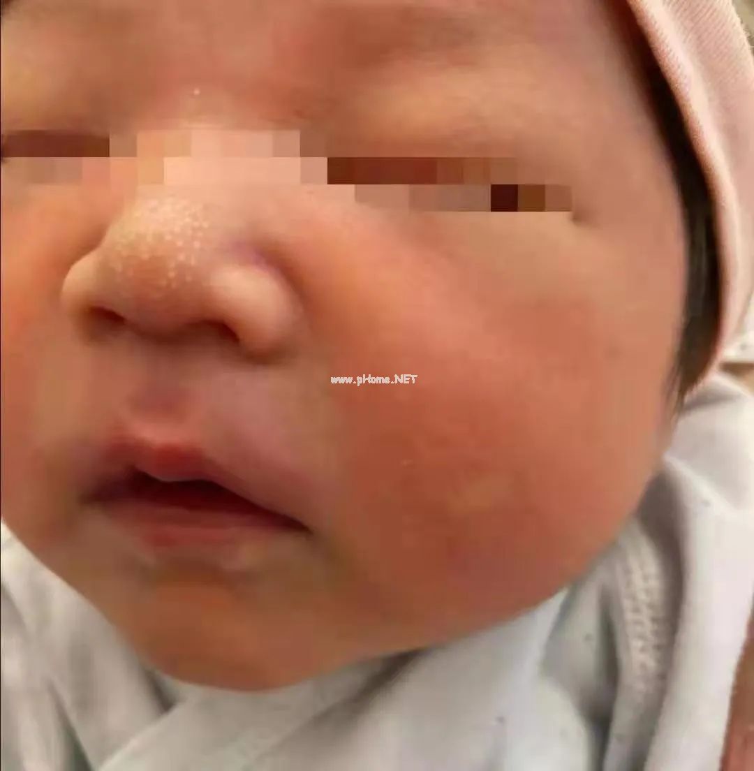 儿童皮肤问题：刚出生的宝宝为啥脸上有白斑?