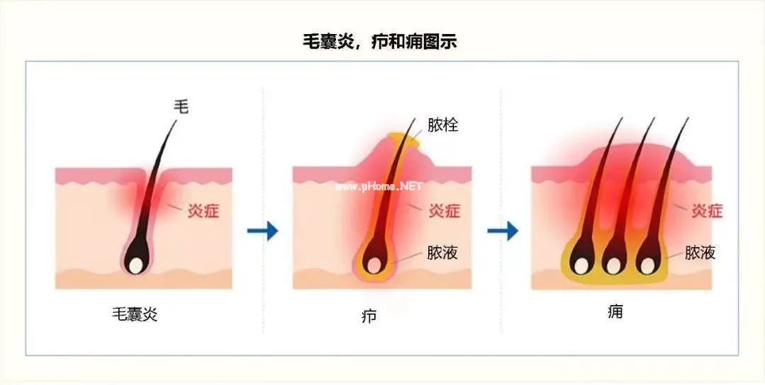 挤了一个小脓包，我的孩子做了胸腔穿刺引流......