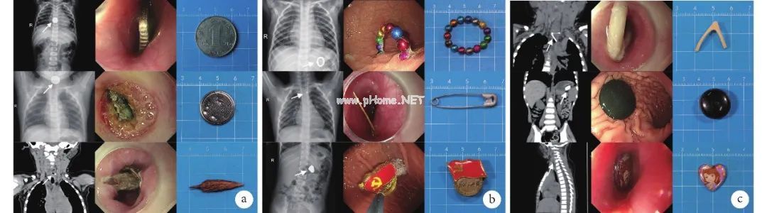 1岁宝宝胃里竟有3根钢钉，儿童消化道异物怎么处理？