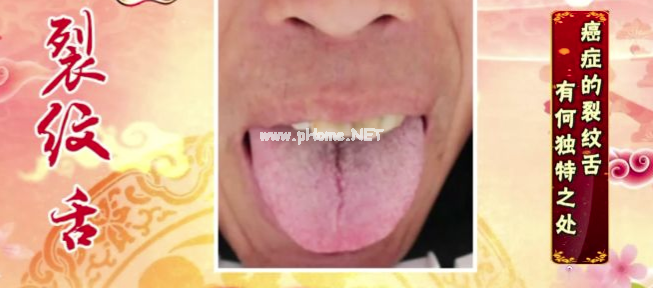 两种舌象：可能是癌症高危人群？