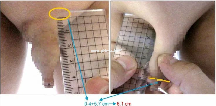 小鸡鸡长度也有国际标准 !  低于这个数，得赶紧看医生