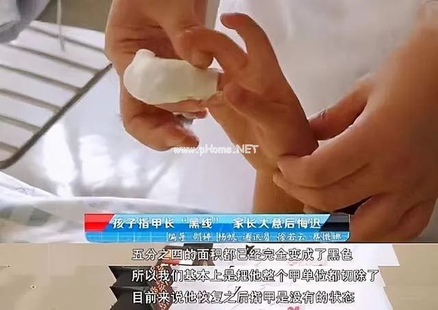 孩子指甲这4种表现是患病信号！第1种可能预示肿瘤