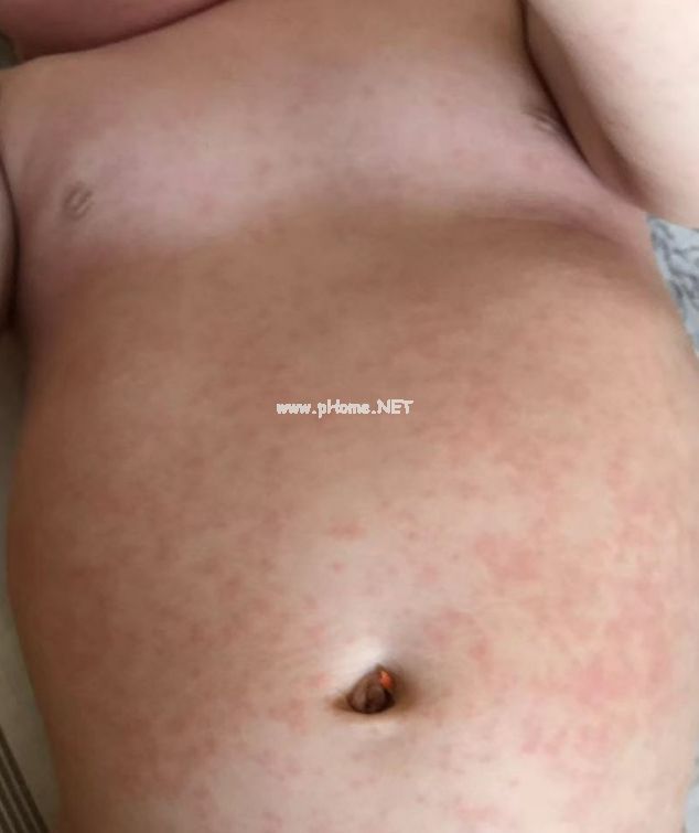遇到幼儿急疹，千万别干这事……