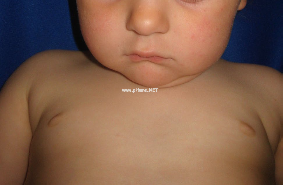 以面部丘疹为例，讨论小儿丘疹性疾病的鉴别
