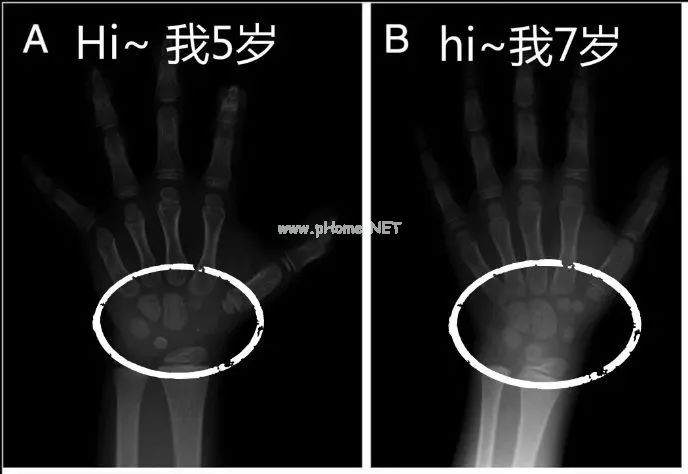 孩子刚8岁就停止长高，妈妈得知真相后悔大哭：这个重要指标，很多家长还不知道！
