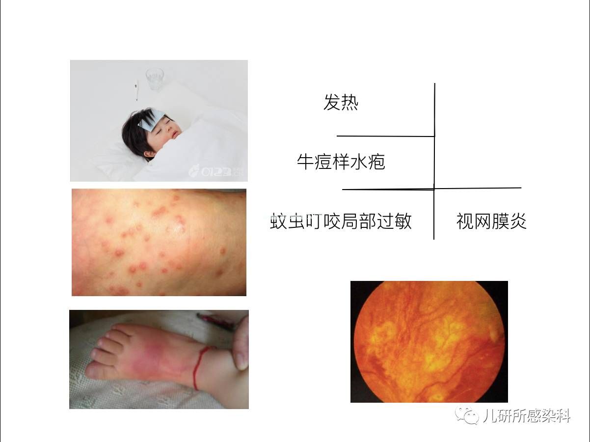 儿童主要非肿瘤性EB病毒感染相关疾病的诊断和治疗原则建议——第三辑