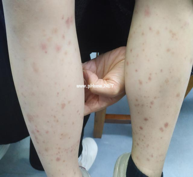 过敏性紫癜患儿突发腹痛，这个并发症一定不能漏诊……