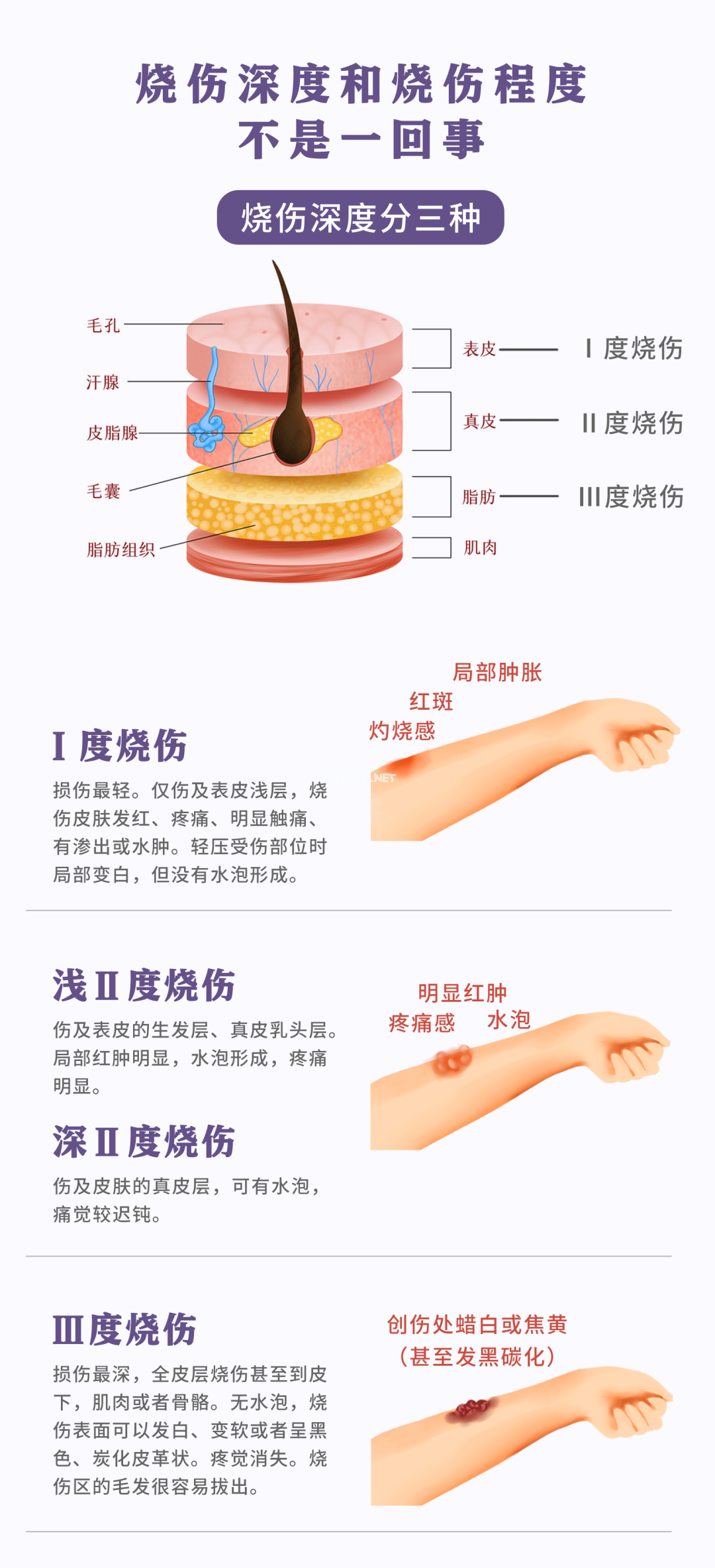 意外烧、烫伤该怎么办？ 华西专家：记住5字秘诀（老辈子带娃必看）