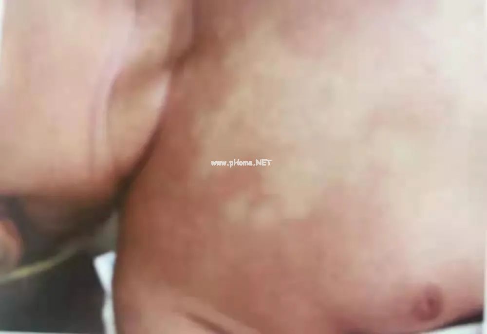 儿童皮肤问题：刚出生的宝宝为啥脸上有白斑?