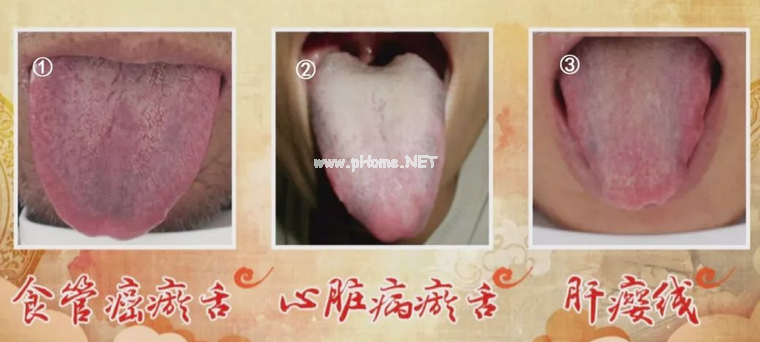两种舌象：可能是癌症高危人群？
