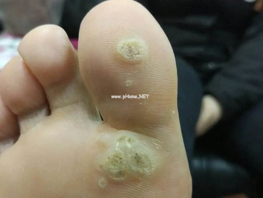孩子身上长瘊子，竟是感染了HPV？