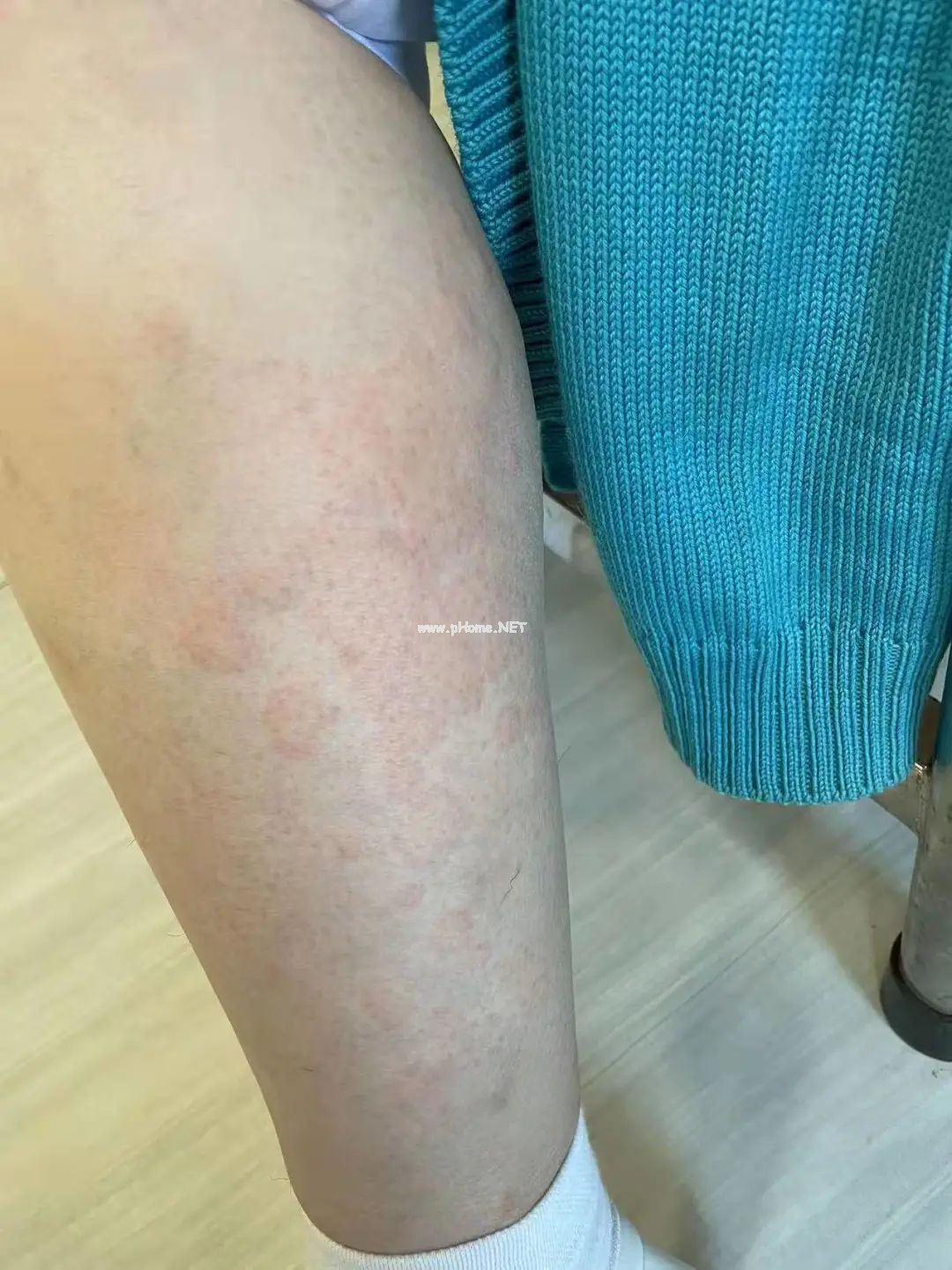 当心！这个春季常见病专挑孩子下手，一定要尽早预防！（不是手足口）