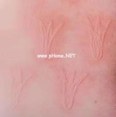 当心！这个春季常见病专挑孩子下手，一定要尽早预防！（不是手足口）