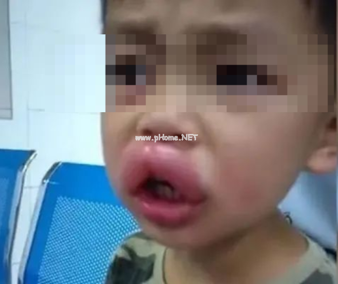 当心!这个春季常见病专挑孩子下手,一定要尽早预防!(不是手足口) 当心!这个春季常见病专挑孩子下手,一定要尽早预防!(不是手足口)