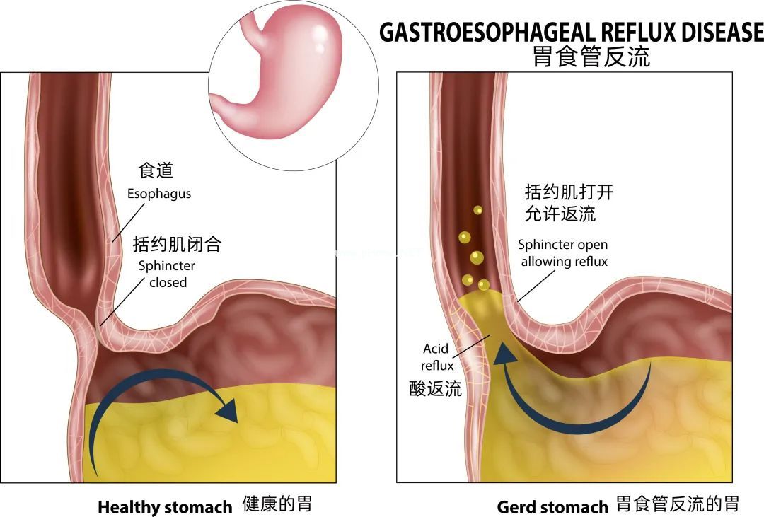 孩子晚上咳得厉害，白天不咳或少咳，是什么原因？要担心吗？