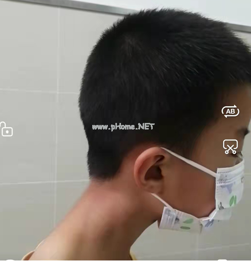 7岁男孩偶有“公鸡打鸣”姿势，这个病常被误诊、漏诊