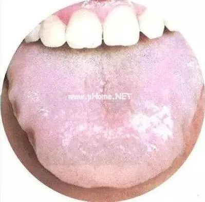 舌头一旦出现这个信号：重视一下。