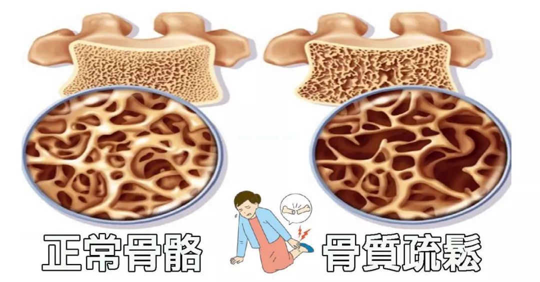 膏方在骨质疏松领域开疆辟土