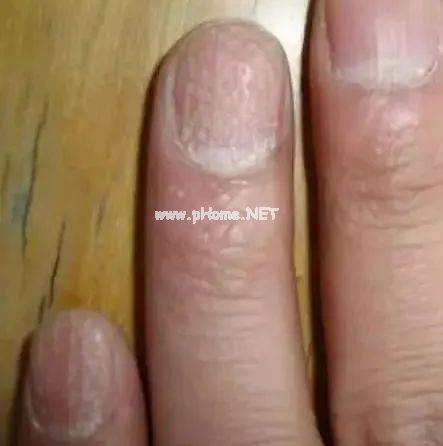 孩子指甲这4种表现是患病信号！第1种可能预示肿瘤