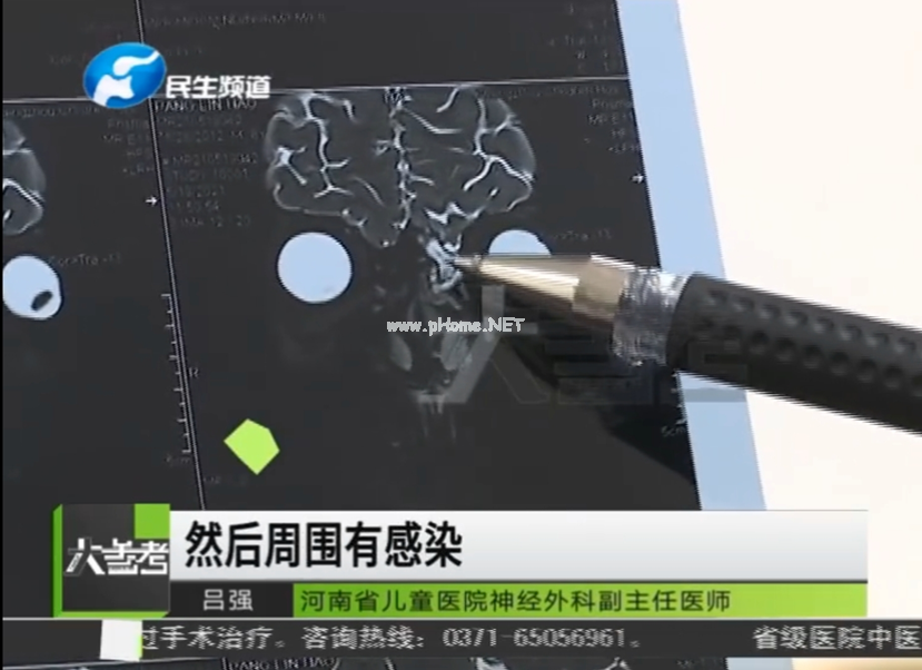 以为是鼻涕，结果是脑脊液，孩子的“鼻涕”没那么简单