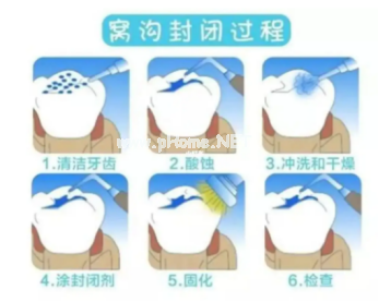 防龋率90%以上！世卫组织强烈推荐的护牙方法，你家孩子做了吗？