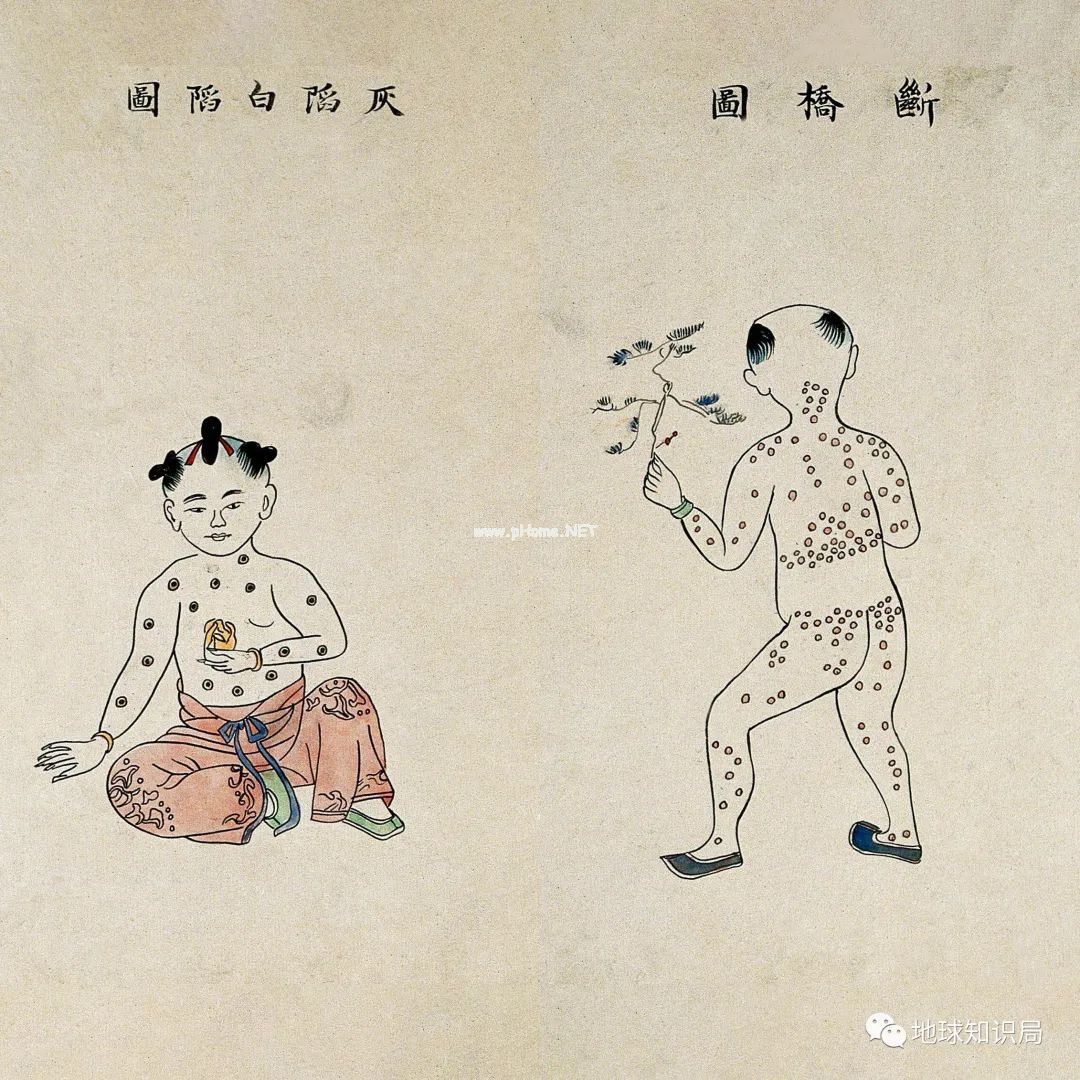 早就被人类消灭的天花，又出现了……