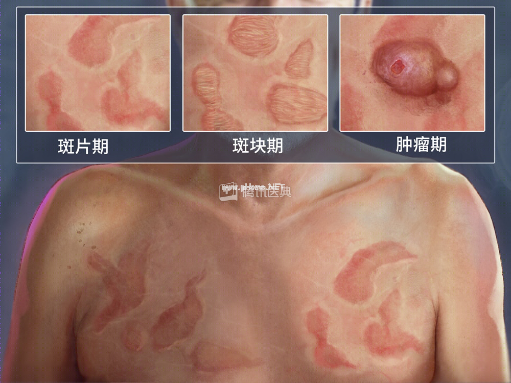 5岁女孩长白斑，以为有蛔虫，3年后发现是肿瘤