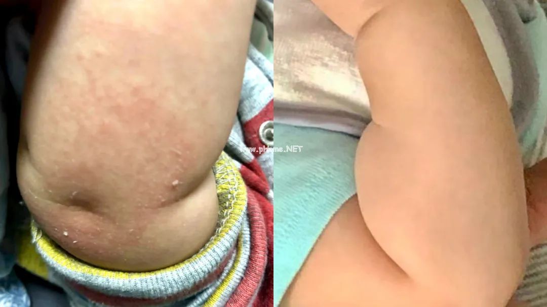 明明70%的湿疹都是轻症，为什么你家孩子就是治不好？
