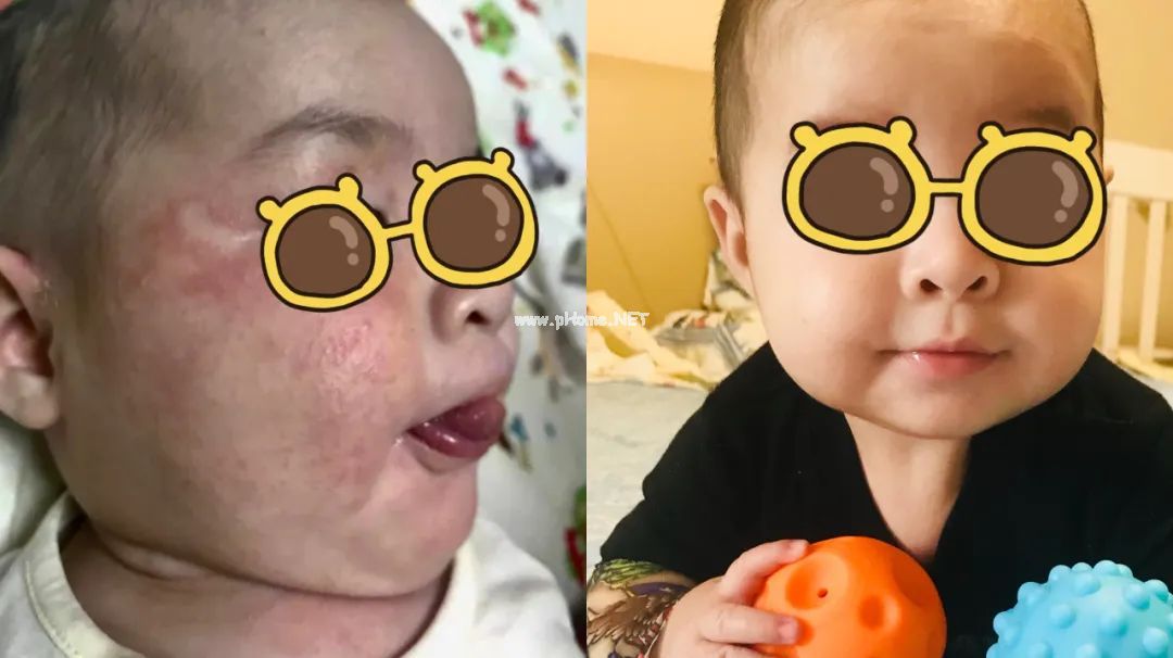 明明70%的湿疹都是轻症，为什么你家孩子就是治不好？