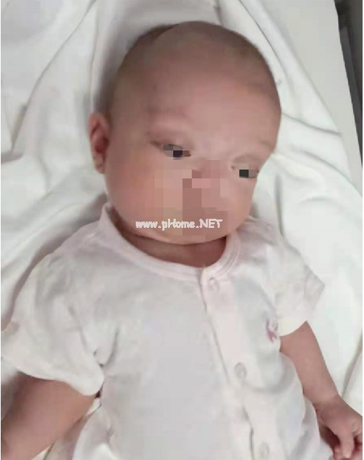 精灵耳、宽脑门、厚嘴唇、长四肢……宝宝这些特征究竟隐藏着什么疾病 精灵耳、宽脑门、厚嘴唇、长四肢……宝宝这些特征究竟隐藏着什么疾病