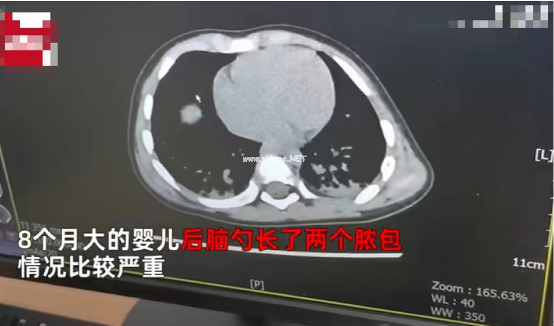 8月宝宝因败血症送进ICU,只因家长这个简单动作...... 8月宝宝因败血症送进ICU,只因家长这个简单动作......