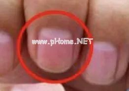 孩子指甲这4种表现是患病信号！第1种可能预示肿瘤