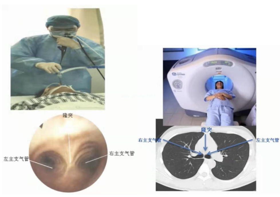 胸部CT6大基本点+8大征象，一节课理清！